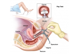 Phết tế bào cổ tử cung : thông thường và Pap Liqui Prep